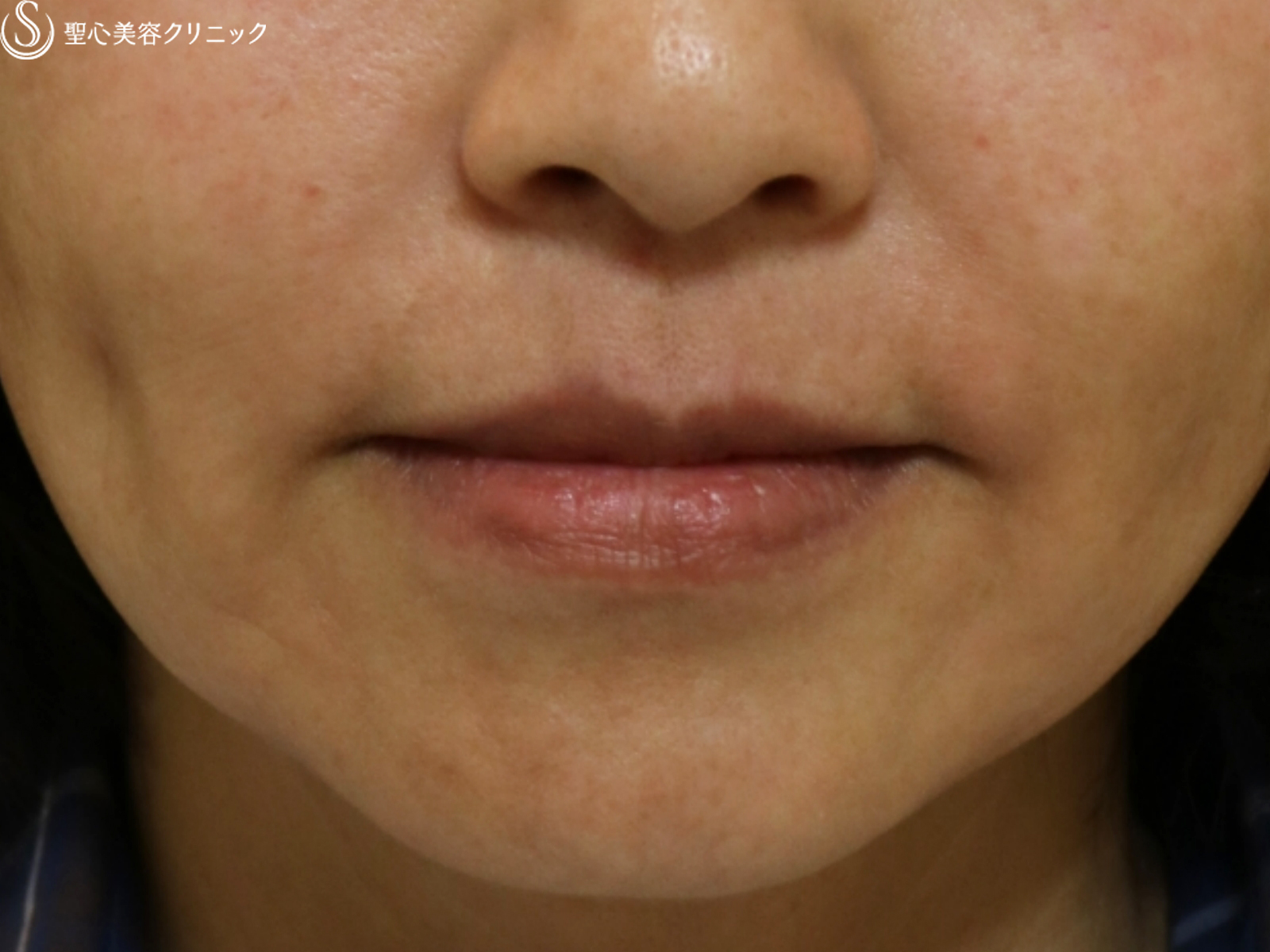 【50代女性・ほうれい線】プレミアムPRP皮膚再生療法（9年後） After 