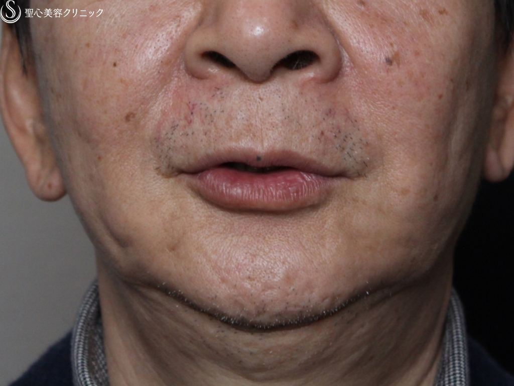 【60代男性・気になるたるみを改善】アンカーマックス 頬とあご下（1ヶ月後） Before 