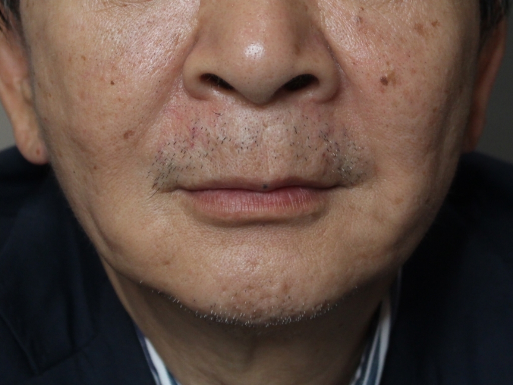 【60代男性・気になるたるみを改善】アンカーマックス 頬とあご下（1ヶ月後） After 