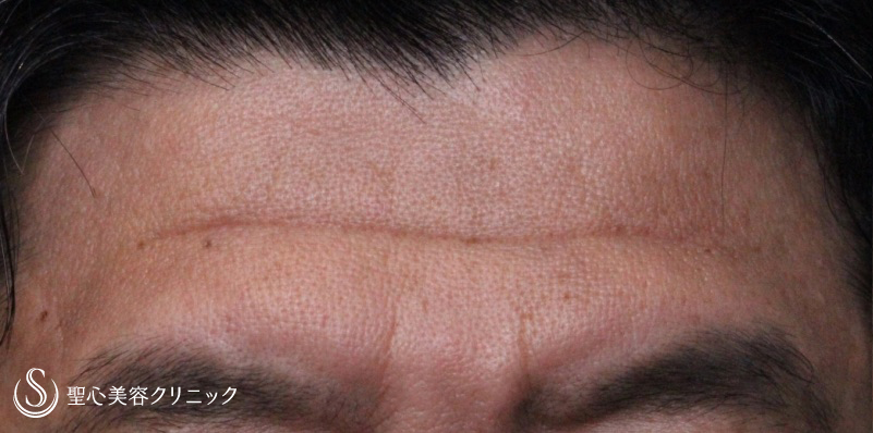 【50代男性・額のしわ、凹み】プレミアムPRP皮膚再生療法（10ヶ月後） Before 
