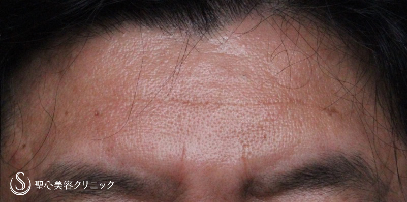【50代男性・額のしわ、凹み】プレミアムPRP皮膚再生療法（10ヶ月後） After 