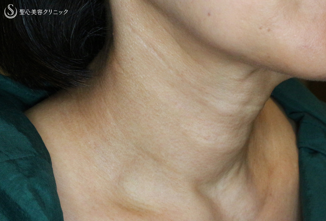 【60代女性・首の横ジワ長期経過】プレミアムPRP皮膚再生療法（5年後） After 