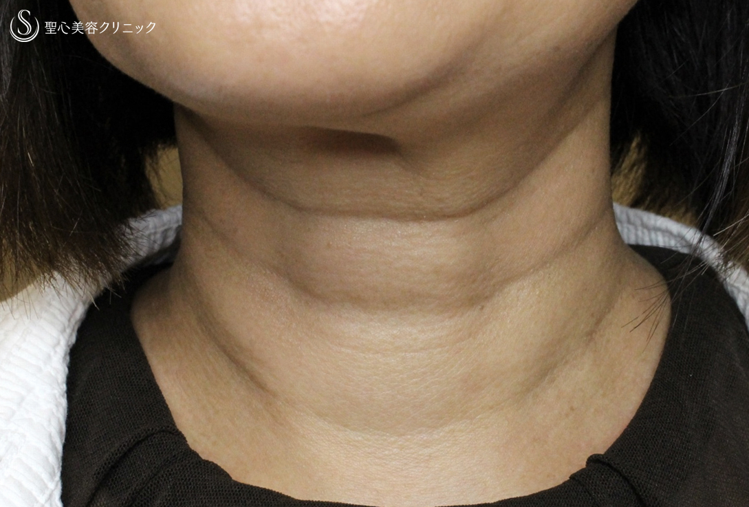 【60代女性・首の横ジワ長期経過】プレミアムPRP皮膚再生療法（5年後） Before 