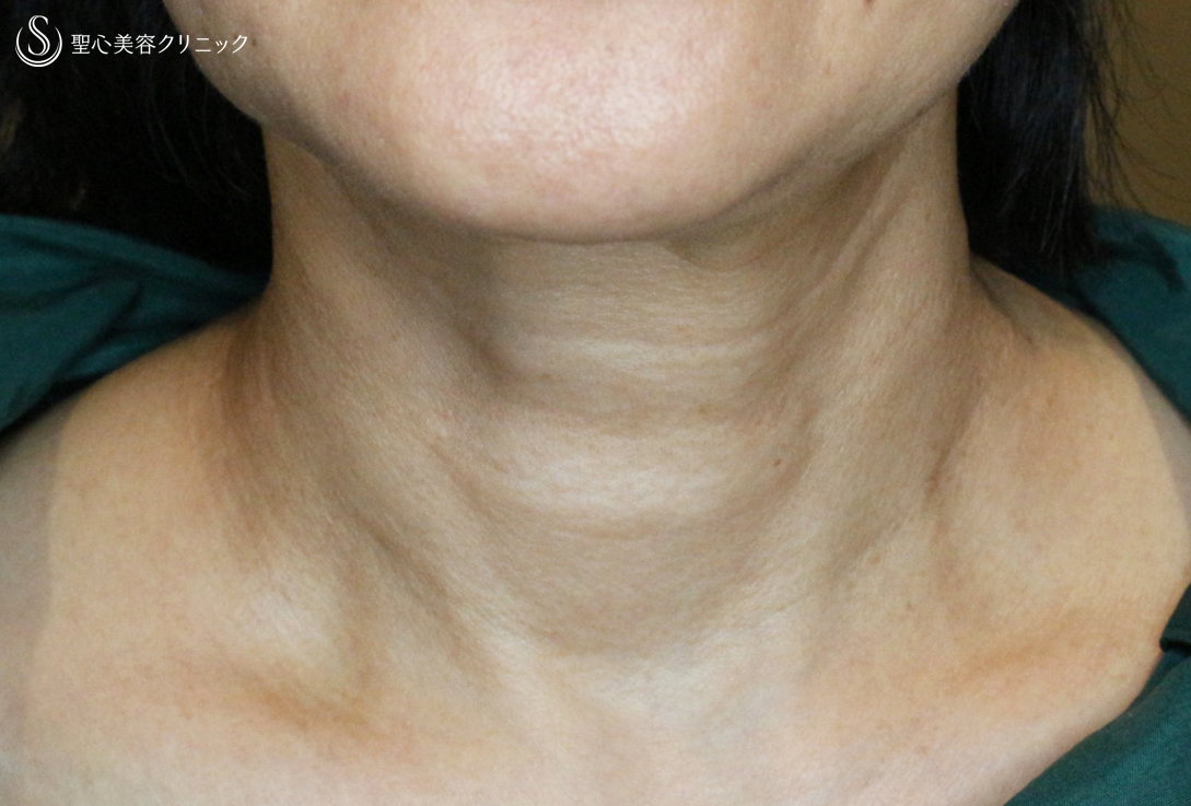 【60代女性・首の横ジワ長期経過】プレミアムPRP皮膚再生療法（5年後） After 