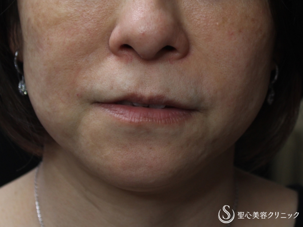 【50代女性・頬のたるみが改善】アンカーマックス（糸のリフト）（1ヵ月後） Before 