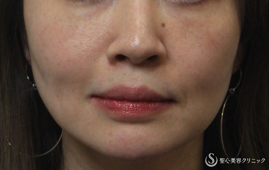 【30代女性・目の下とほうれい線】プレミアムPRP皮膚再生療法 After 
