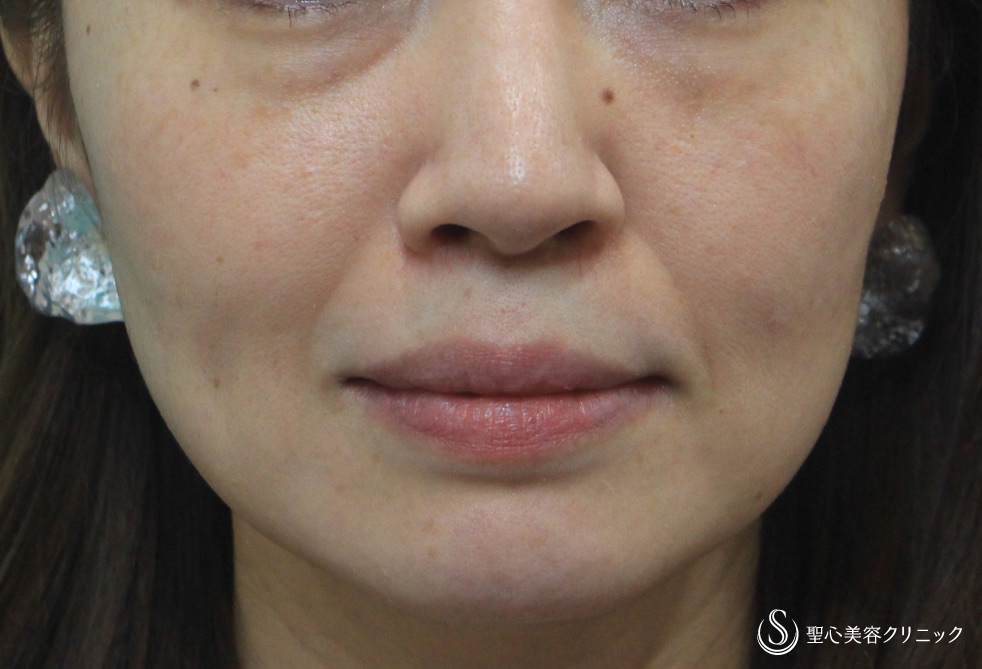 【30代女性・目の下とほうれい線】プレミアムPRP皮膚再生療法 Before 