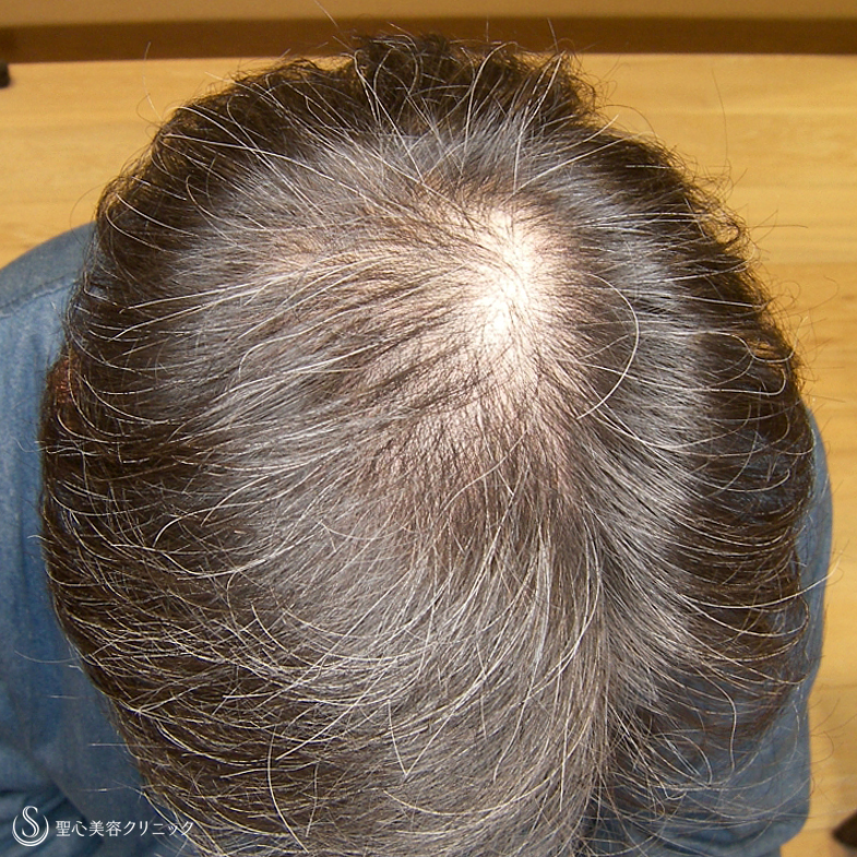 【40代男性・白髪＆髪質の改善まで】グロースファクター毛髪再生療法（6回後） Before 