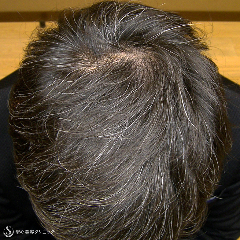 【40代男性・白髪＆髪質の改善まで】グロースファクター毛髪再生療法（6回後） After 