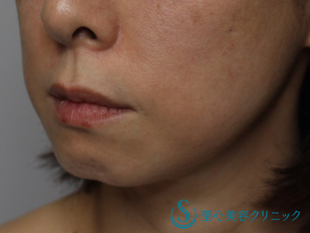 【40代女性・頬のたるみを改善】糸のリフト（アンカーマックス）+顎のヒアルロン酸（直後） Before 