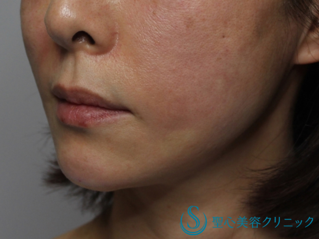 【40代女性・頬のたるみを改善】糸のリフト（アンカーマックス）+顎のヒアルロン酸（直後） After 