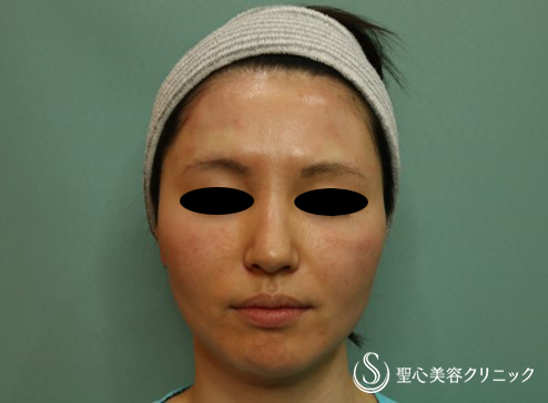 【30代女性・軽度のたるみ】アキュパンクチュアリフト After 