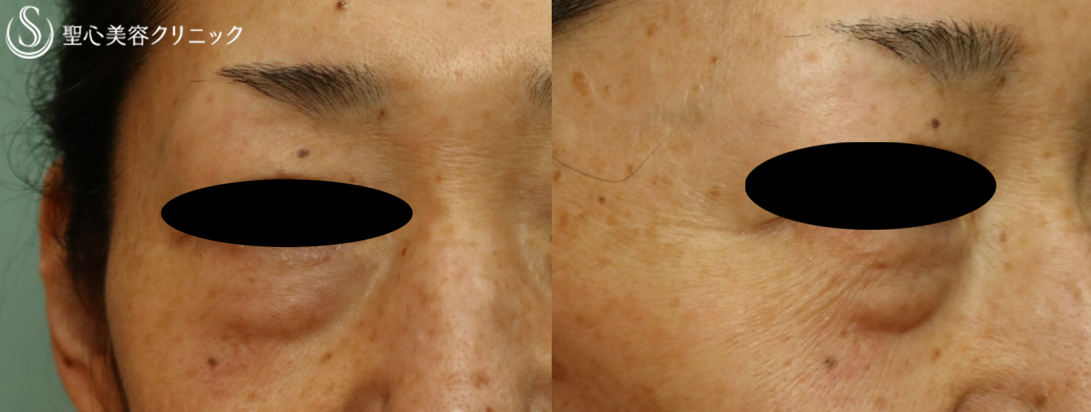 【50代女性・目の下のくま】プレミアムPRP皮膚再生療法→経結膜下脱脂（1ヶ月後） Before 