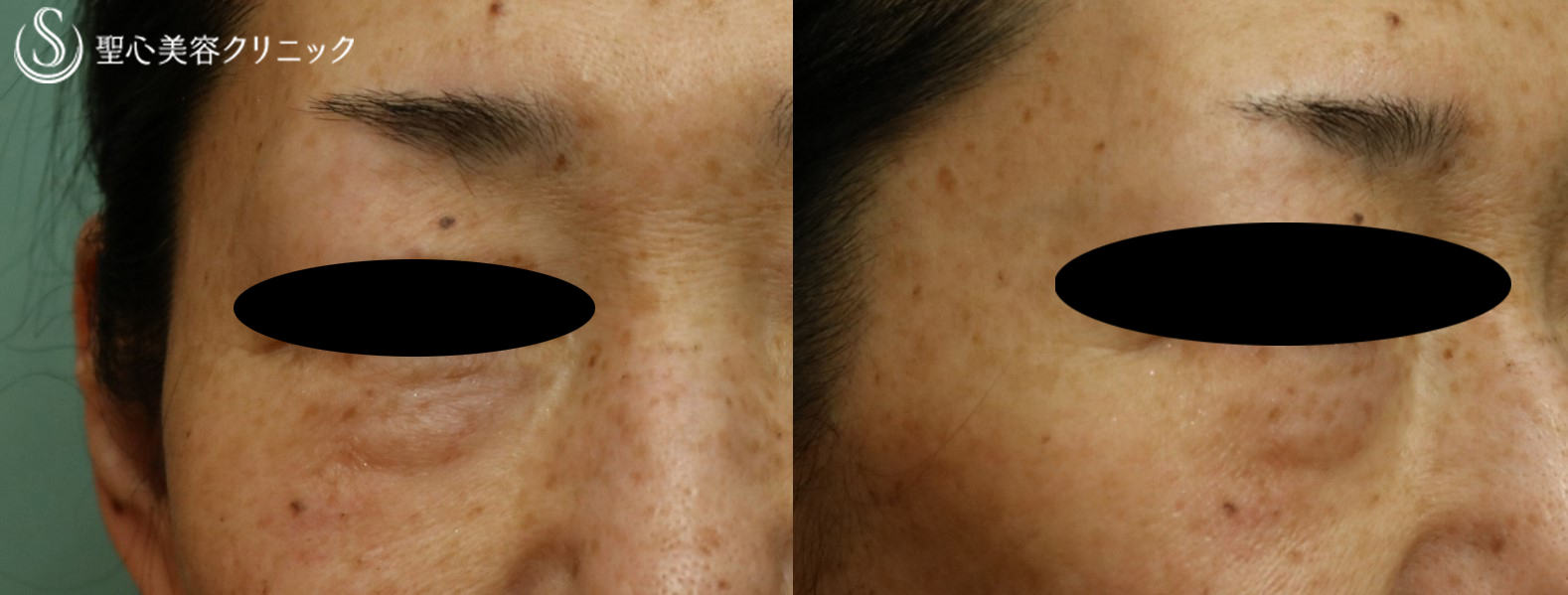 【50代女性・目の下のくま】プレミアムPRP皮膚再生療法→経結膜下脱脂（1ヶ月後） Before 