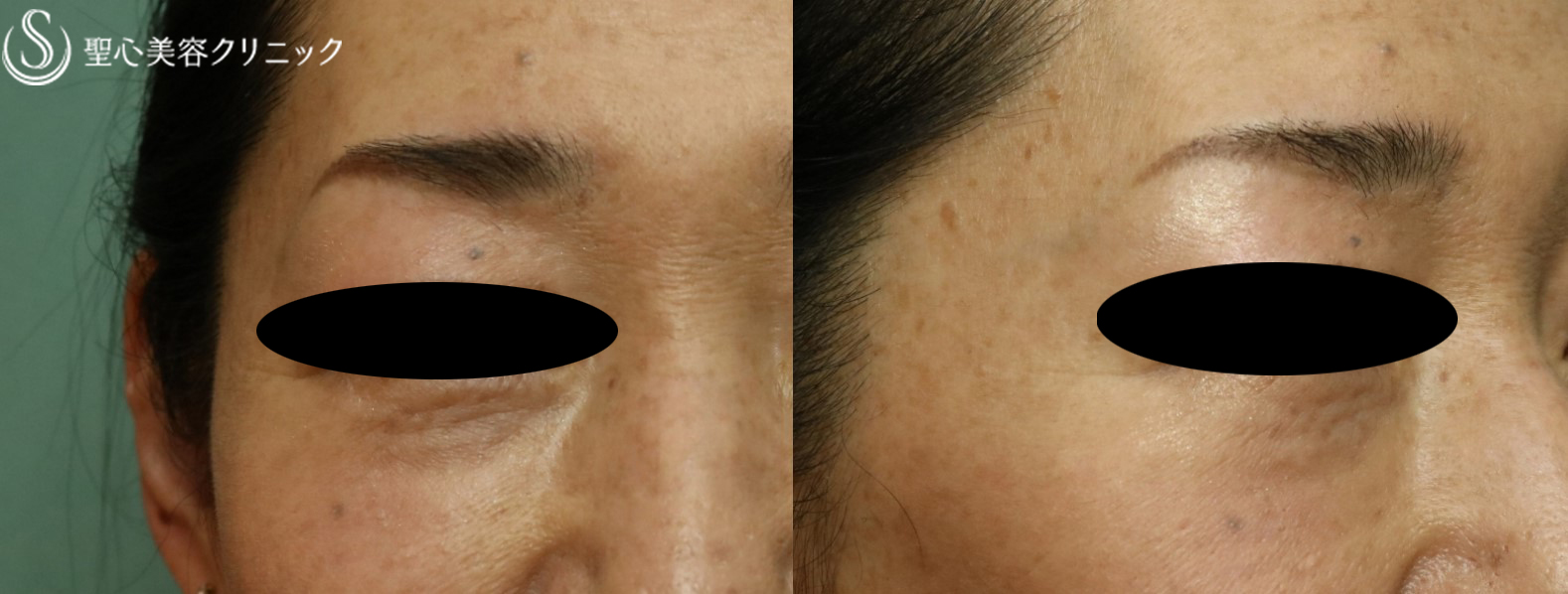 【50代女性・目の下のくま】プレミアムPRP皮膚再生療法→経結膜下脱脂（1ヶ月後） After 
