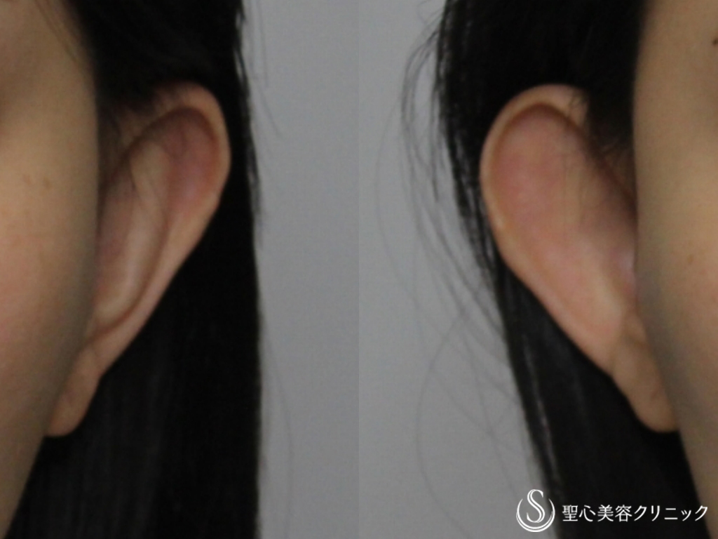 【30代女性・立ち耳の修正】立ち耳（埋没法）（直後） Before 