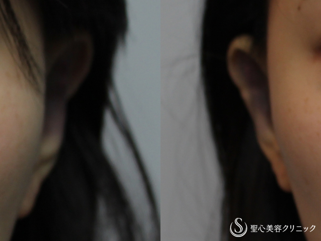 【30代女性・立ち耳の修正】立ち耳（埋没法）（直後） After 