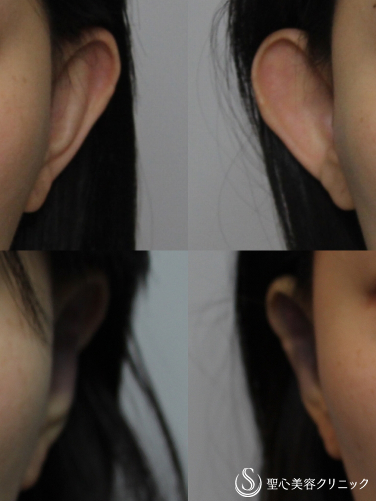 【30代女性・立ち耳の修正】立ち耳（埋没法）（直後） After 