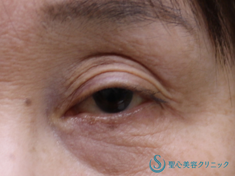 【60代女性・目の開きを改善】眼瞼下垂（埋没法）（術直後） Before 
