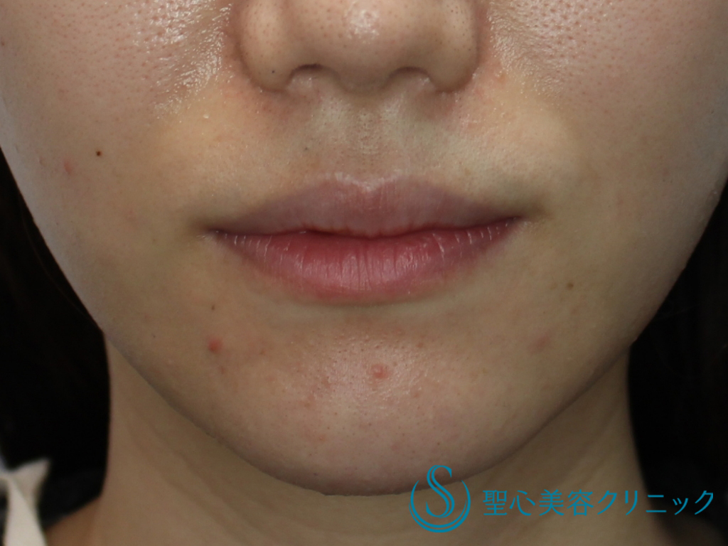 華やかな印象に プレミアム口角挙上術 1週間後 症例写真 美容整形 美容外科なら聖心美容クリニック