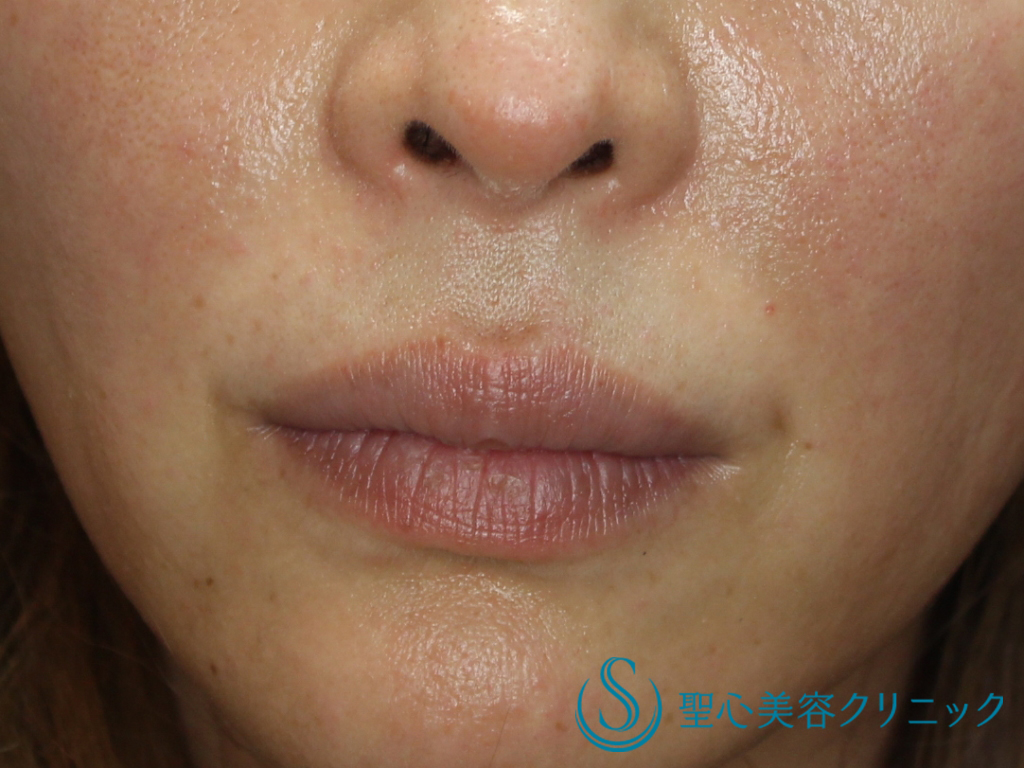 メリハリのある口元へ プレミアム口角挙上術 M字リップ 1週間後 1ヶ月後 症例写真 美容整形 美容外科なら聖心美容クリニック