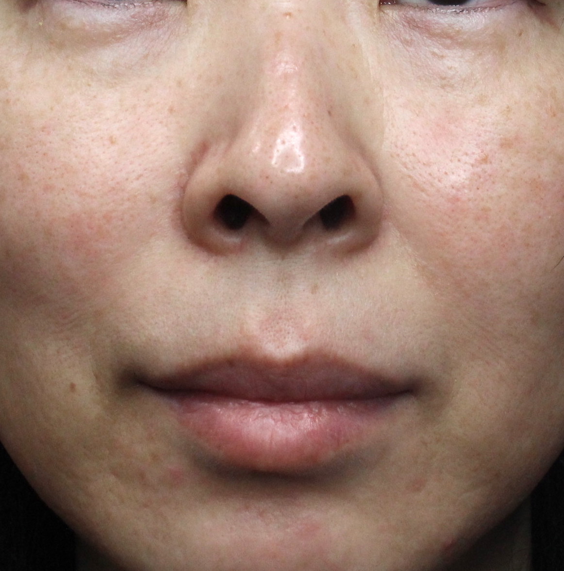 【40代女性・鼻と唇の距離を短くして若々しく】リップリフト（1ヶ月後） 症例写真 美容整形、美容外科なら聖心美容クリニック