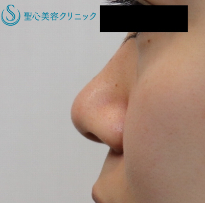 【20代女性・鼻先を高く】鼻尖縮小と耳介軟骨移植（1ヶ月後） Before 