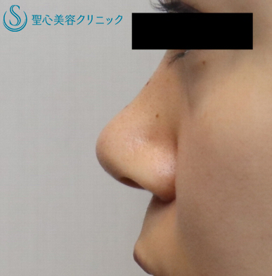 【20代女性・鼻先を高く】鼻尖縮小と耳介軟骨移植（1ヶ月後） After 