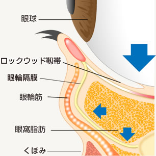 脂肪のたるみによるくまの原因