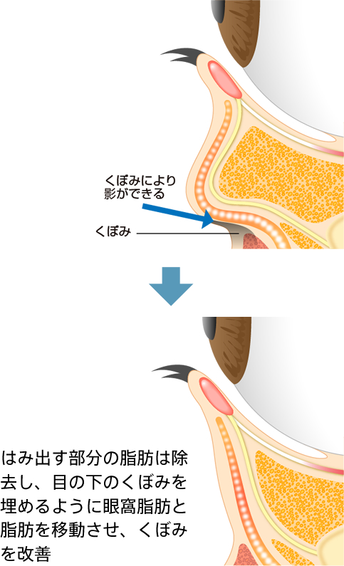 凹み・くぼみによるくまの原因