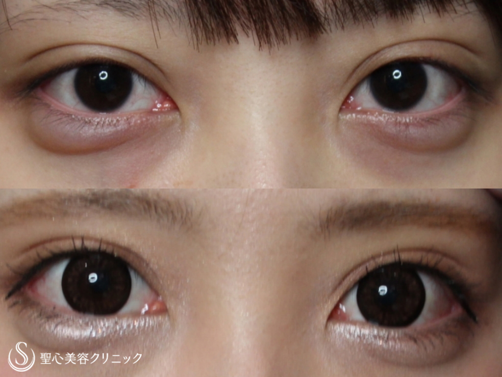 【20代女性・目を大きく】目尻切開、グラマラスライン（たれ目）形成（1ヶ月後） 症例写真 美容整形、美容外科なら聖心美容クリニック
