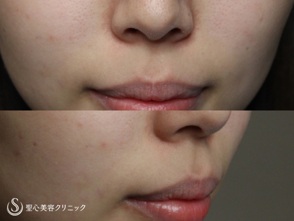 代女性 鼻の下を短く リップリフト 3ヶ月後 症例写真 美容整形 美容外科なら聖心美容クリニック