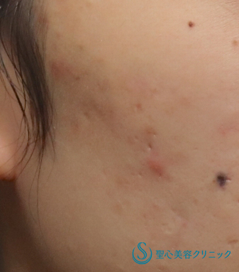 代女性 ニキビ跡を綺麗に イントラセル 6ヶ月後 症例写真 美容整形 美容外科なら聖心美容クリニック