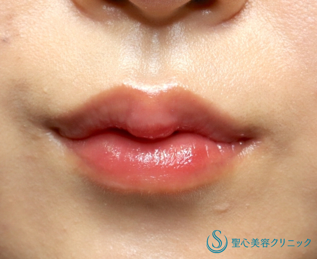 【20代女性・８ヶ月後もかわいい唇】スマイルリップ（ヒアルロン酸＋ボトックス）（8ヶ月後） After 