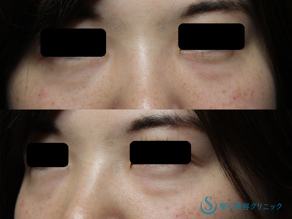 【30代女性・気になる目のクマに】目の下のクマ、たるみ取り（プレミアムPRP皮膚再生療法）（7ヶ月後） Before 