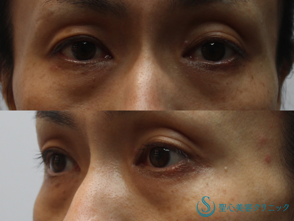 【40代女性・くぼみを改善】プレミアムPRP皮膚再生療法（目の上のくぼみ、目の下のクマ、たるみ）（3年後） Before 