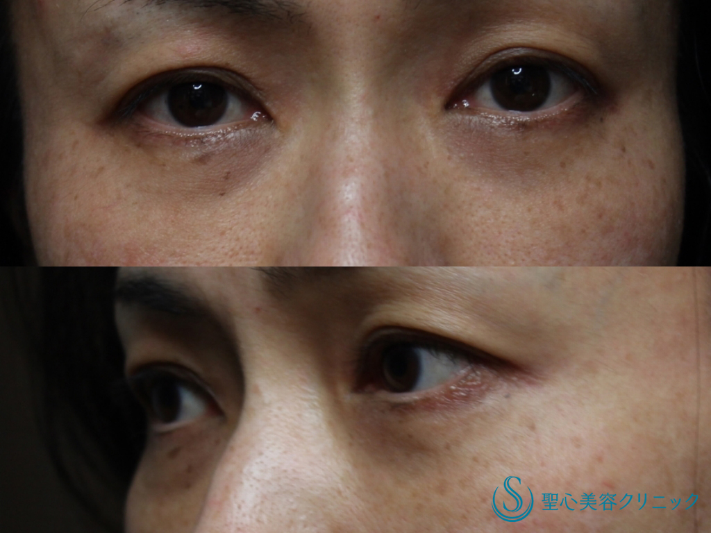 【40代女性・くぼみを改善】プレミアムPRP皮膚再生療法（目の上のくぼみ、目の下のクマ、たるみ）（3年後） After 