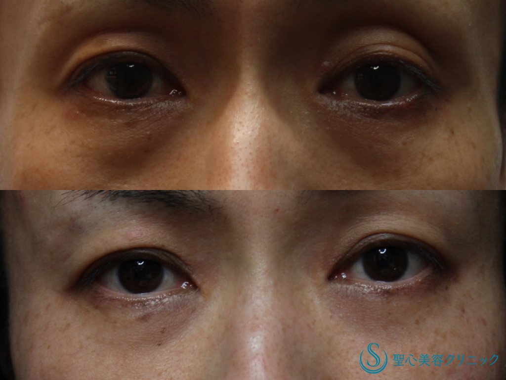 【40代女性・くぼみを改善】プレミアムPRP皮膚再生療法（目の上のくぼみ、目の下のクマ、たるみ）（3年後） After 