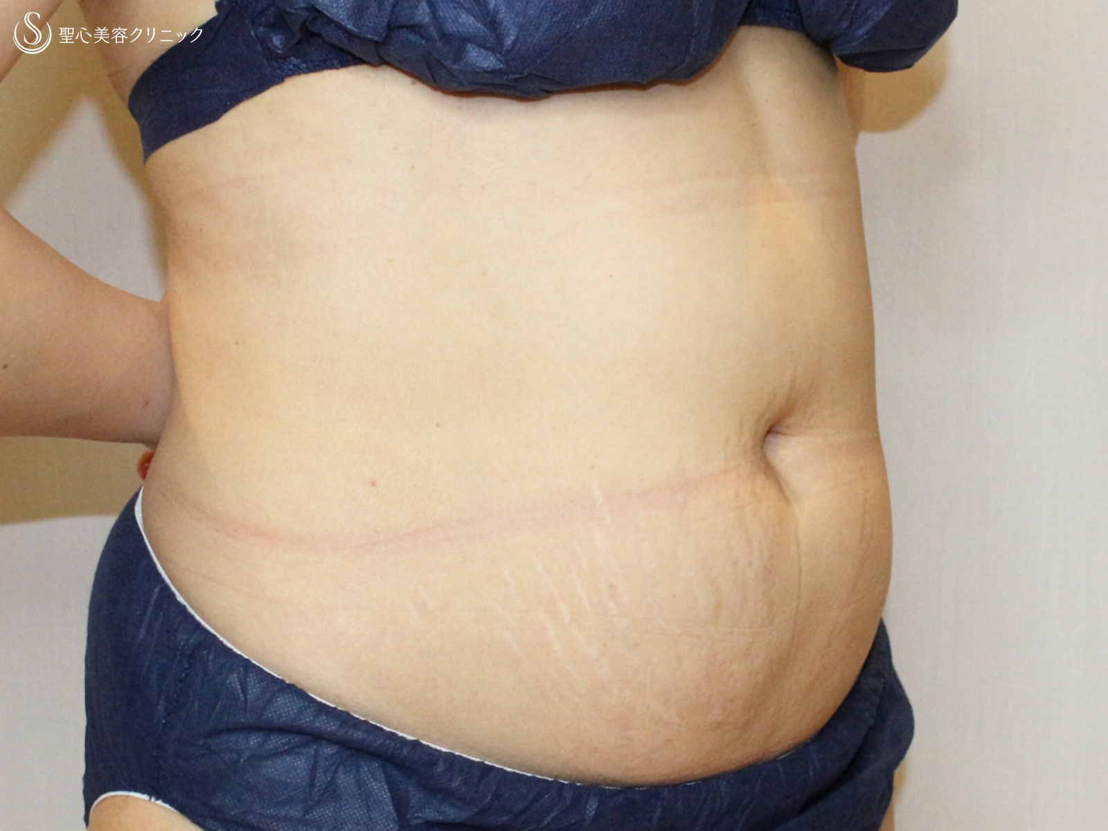 【30代女性・切らないお腹の痩身】リポセルモニター（3ヶ月後） Before 