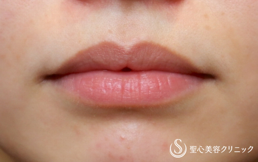 【20代女性・綺麗に口角アップ】プレミアム口角挙上(2ヵ月後) - 症例写真 - 美容整形、美容外科なら聖心美容クリニック