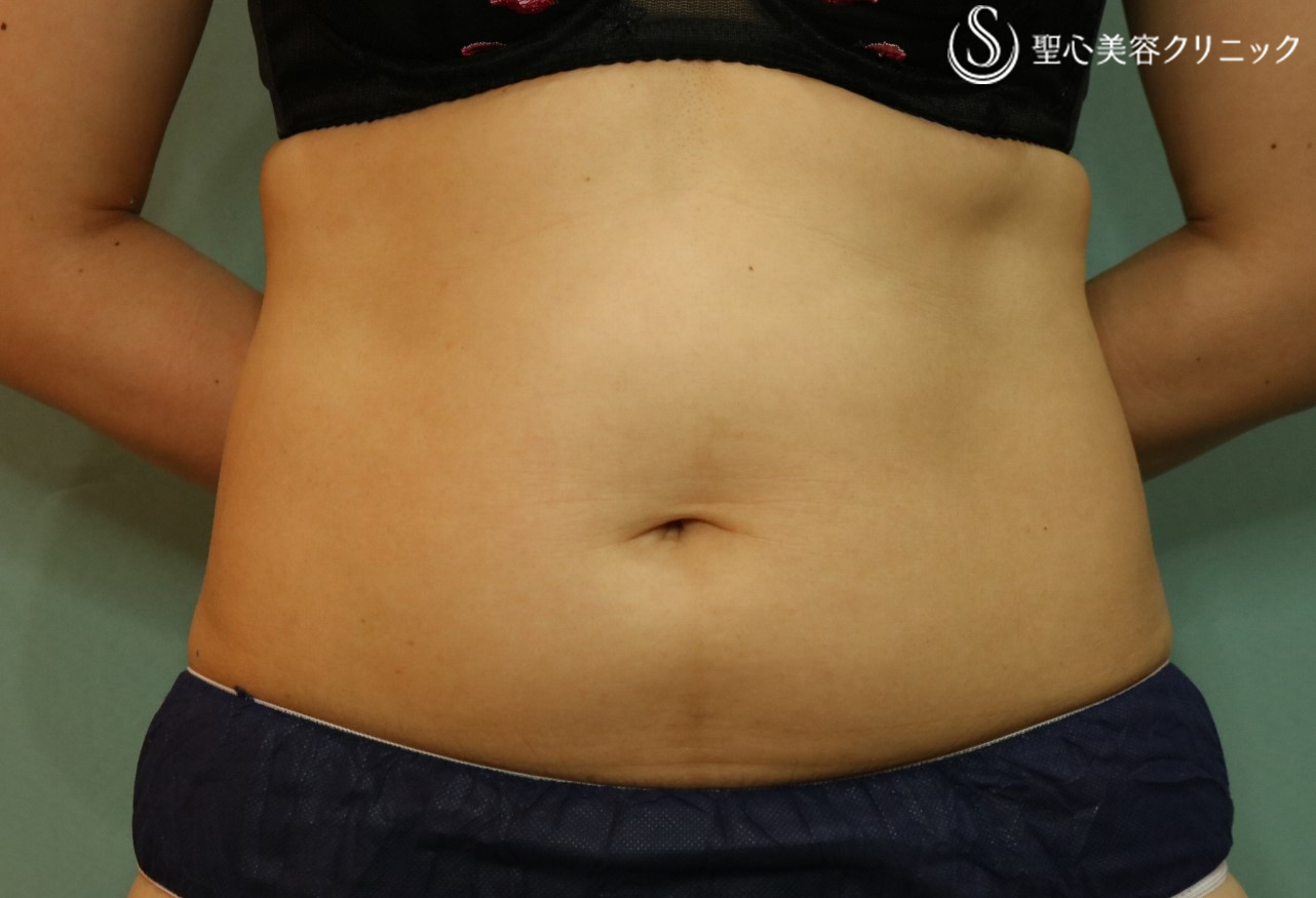 【40代女性・腹部痩身】リポセル（3ヶ月後） Before 
