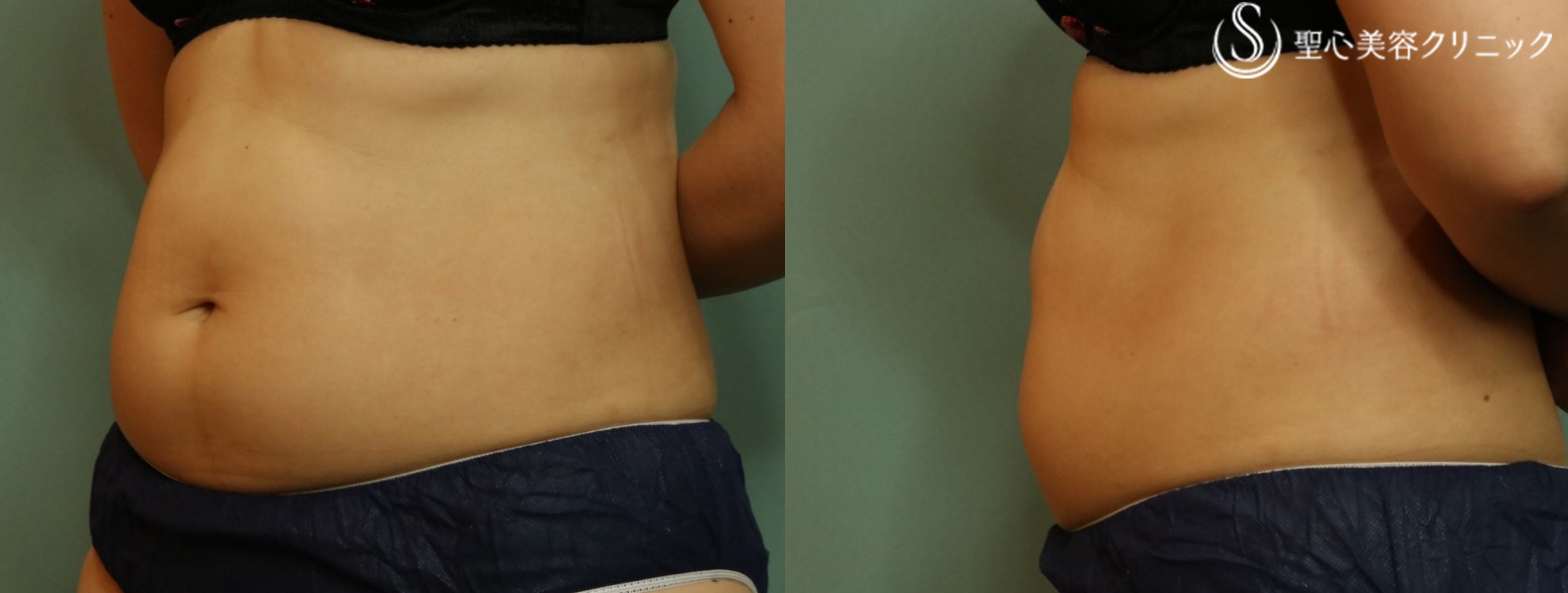 【40代女性・腹部痩身】リポセル（3ヶ月後） Before 