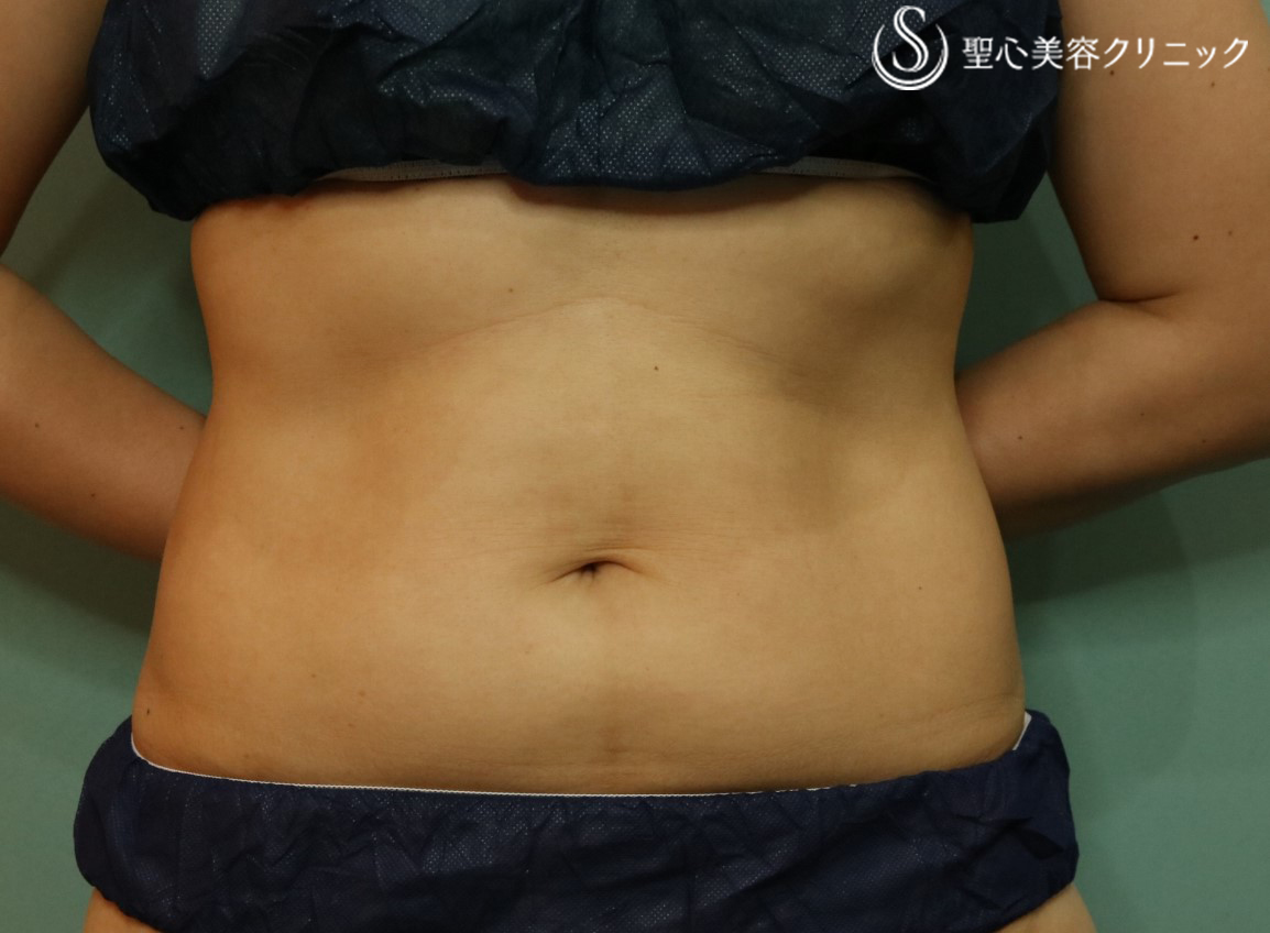 【40代女性・腹部痩身】リポセル（3ヶ月後） After 