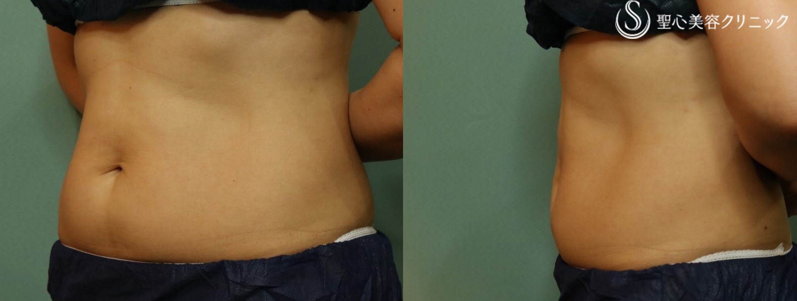 【40代女性・腹部痩身】リポセル（3ヶ月後） After 