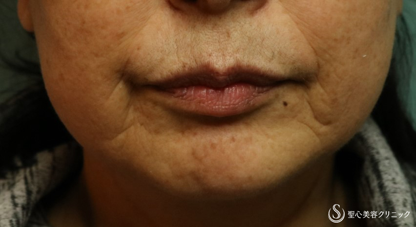 【60代女性・マリオネットラインのシワに】プレミアムPRP皮膚再生療法（3ヶ月後） Before 