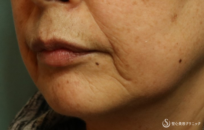 【60代女性・マリオネットラインのシワに】プレミアムPRP皮膚再生療法（3ヶ月後） Before 