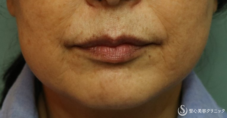 【60代女性・マリオネットラインのシワに】プレミアムPRP皮膚再生療法（3ヶ月後） After 