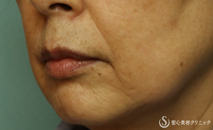 【60代女性・マリオネットラインのシワに】プレミアムPRP皮膚再生療法（3ヶ月後） After 