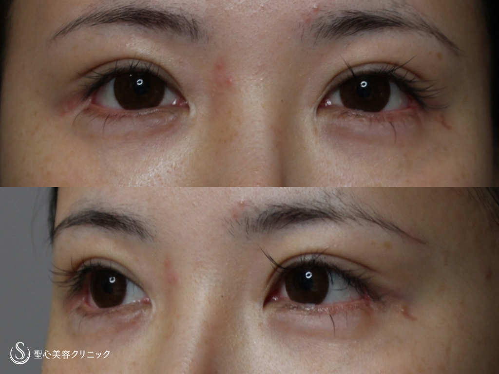 代女性 二重の上と目頭がすっきり 眉下切開 目頭切開 術後半年 症例写真 美容整形 美容外科なら聖心美容クリニック 代女性 二重の上と目頭がすっきり 眉下切開 目頭切開 術後半年 症例写真 美容整形 美容外科なら聖心美容クリニック
