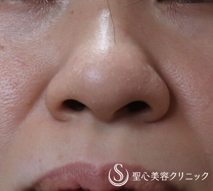 【40代女性・鼻の穴を目立たなく】小鼻縮小（7ヶ月後） Before 
